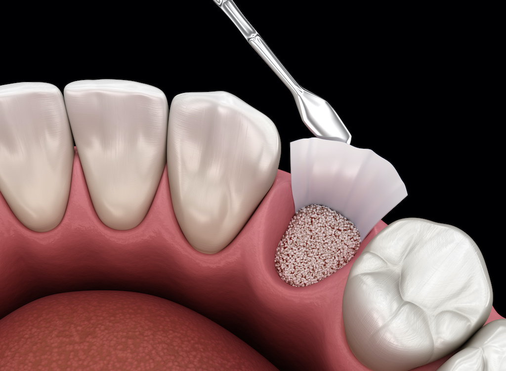 Fixed Artificial Teeth